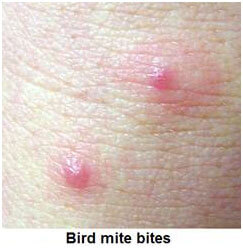 Bird Mites Rash